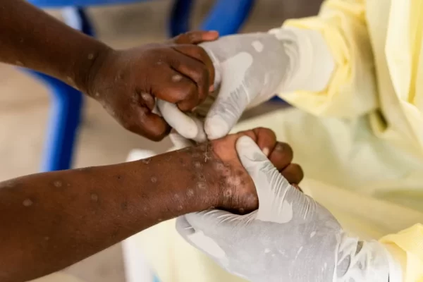 Niassa volta a registar casos de “Mpox”