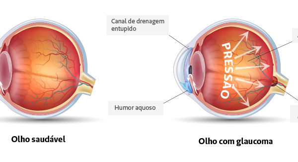 DIA MUNDIAL DO GLAUCOMA: Apenas dois especialistas para dez mil pacientes