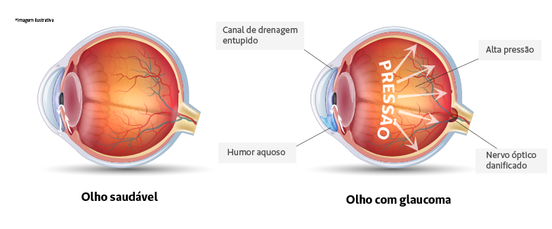 DIA MUNDIAL DO GLAUCOMA: Apenas dois especialistas para dez mil pacientes